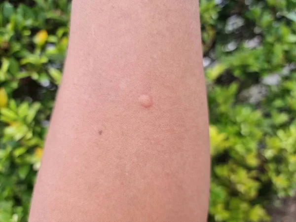 Eine Mücke Sticht Eine Blase Arm — Stockfoto