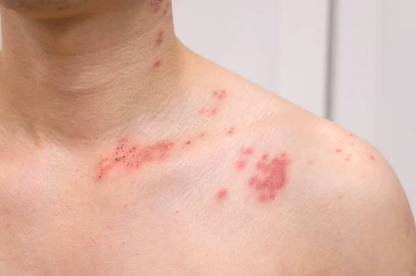 close up of man with shingles disease on skin