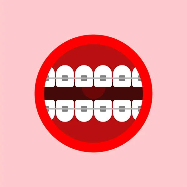 Mund Mit Zahnspange Isoliert Korrektur Von Okklusion Und Schiefen Zähnen — Stockvektor