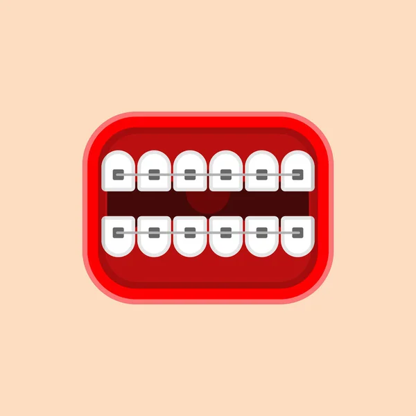 Mund Mit Zahnspange Isoliert Korrektur Von Okklusion Und Schiefen Zähnen — Stockvektor