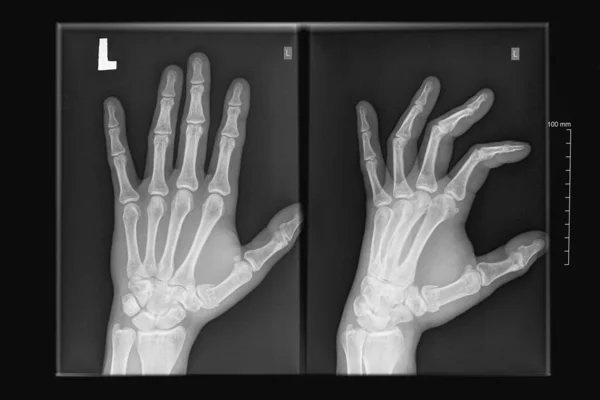 X-ray image of human hands, arm fracture