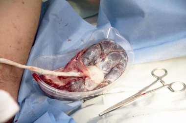 Doğumdan sonra insan plasentası