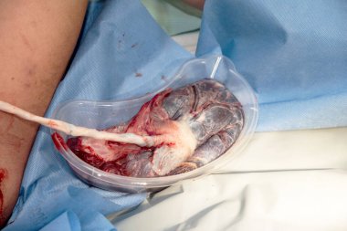 Doğumdan sonra insan plasentası