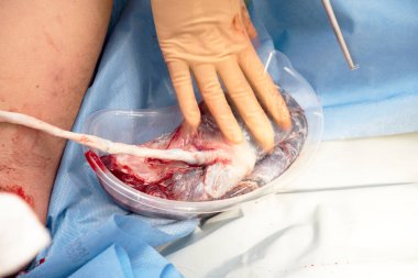 Doğumdan sonra insan plasentası