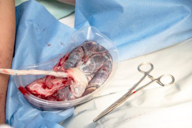 Doğumdan sonra insan plasentası