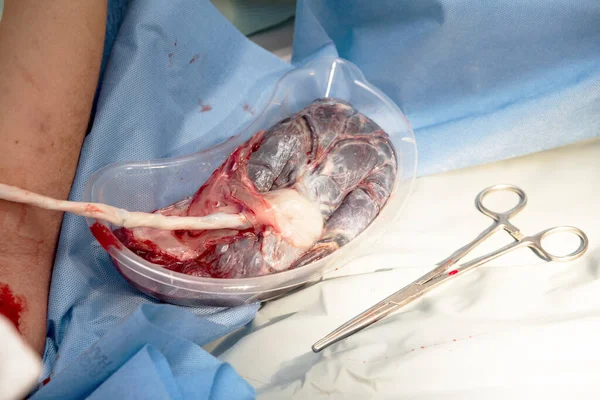 Doğumdan sonra insan plasentası