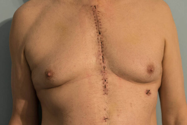 The chest of a man who underwent cardiac surgery, insertion of aortoventricular bypass. There is a healing wound running across the sternum, two small probe wounds on the abdomen.