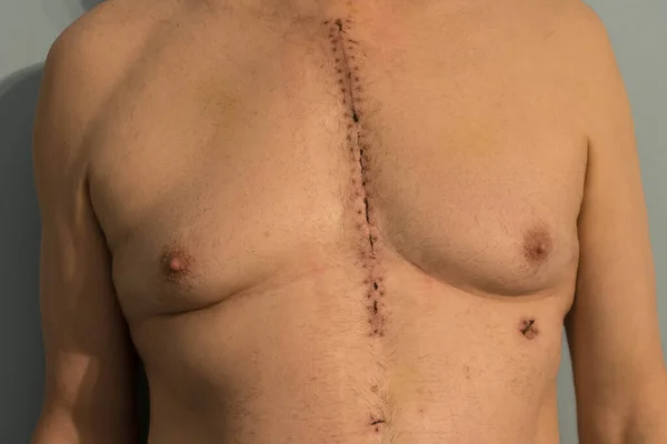 Tórax Homem Que Foi Submetido Cirurgia Cardíaca Inserção Bypass Aortoventricular — Fotografia de Stock