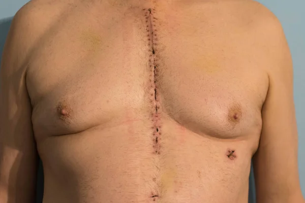 Tórax Homem Que Foi Submetido Cirurgia Cardíaca Inserção Bypass Aortoventricular — Fotografia de Stock