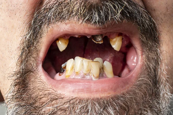 Zgniłe Przednie Zęby Białego Brodatego Mężczyzny Miękkie Skupienie Bliska — Zdjęcie stockowe