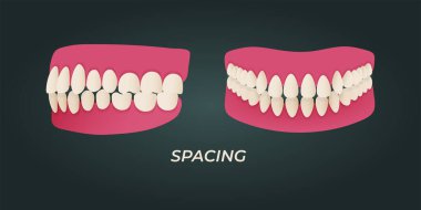 Human teeth malocclusion set with realistic images of mouth jaws with crooked teeth and text captions. Normal and abnormal occlusion. Vector illustration