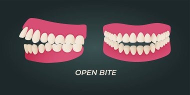 Human teeth malocclusion set with realistic images of mouth jaws with crooked teeth and text captions. Normal and abnormal occlusion. Vector illustration