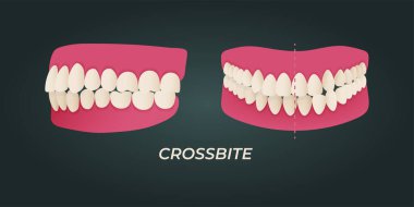 Human teeth malocclusion set with realistic images of mouth jaws with crooked teeth and text captions. Normal and abnormal occlusion. Vector illustration clipart