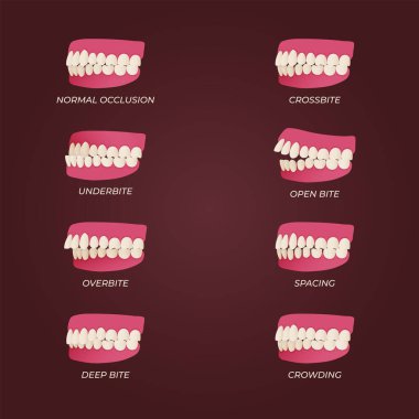 Human teeth malocclusion set with realistic images of mouth jaws with crooked teeth and text captions. Normal and abnormal occlusion. Vector illustration