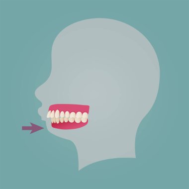 Human teeth malocclusion set with realistic images of mouth jaws with crooked teeth and text captions. Normal and abnormal occlusion. Vector illustration