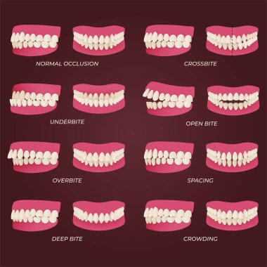 Human teeth malocclusion set with realistic images of mouth jaws with crooked teeth and text captions. Normal and abnormal occlusion. Vector illustration