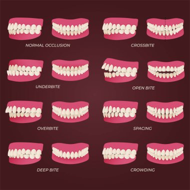 Human teeth malocclusion set with realistic images of mouth jaws with crooked teeth and text captions. Normal and abnormal occlusion. Vector illustration clipart