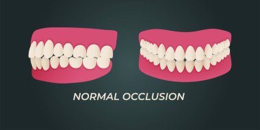 Human teeth malocclusion set with realistic images of mouth jaws with crooked teeth and text captions. Normal and abnormal occlusion. Vector illustration