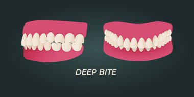Human teeth malocclusion set with realistic images of mouth jaws with crooked teeth and text captions. Normal and abnormal occlusion. Vector illustration