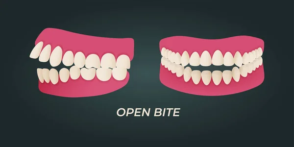 Ανθρώπινο Δόντι Malocclusion Σύνολο Ρεαλιστικές Εικόνες Του Στόματος Σαγόνια Στραβά — Διανυσματικό Αρχείο