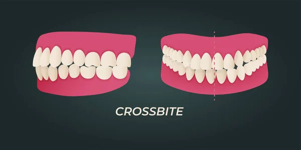 Human Teeth Malocclusion Set Realistic Images Mouth Jaws Crooked Teeth — 图库矢量图片