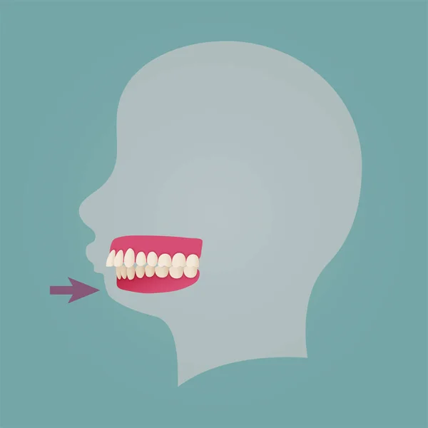 Человеческие Зубы Malocclusion Набор Реалистичными Изображениями Рот Челюсти Кривыми Зубами — стоковый вектор