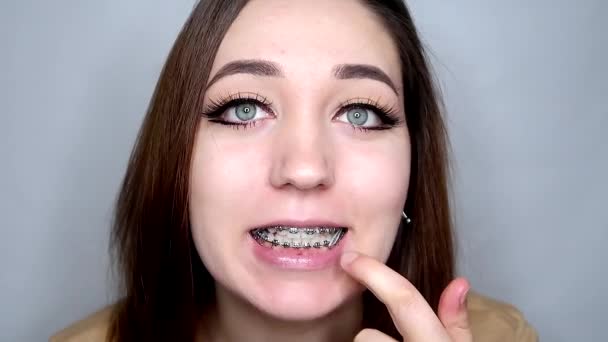 Diş Teli Takan Genç Bayan Ağzını Sonuna Kadar Açar Ortodontik — Stok video