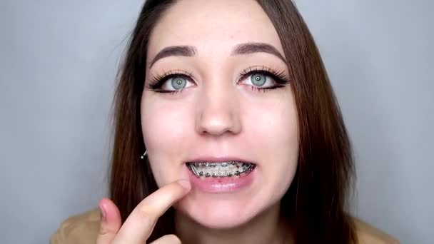 Mladá Dáma Rovnátkách Otevírá Ústa Doširoka Ukazuje Napětí Korekční Ortodontické — Stock video