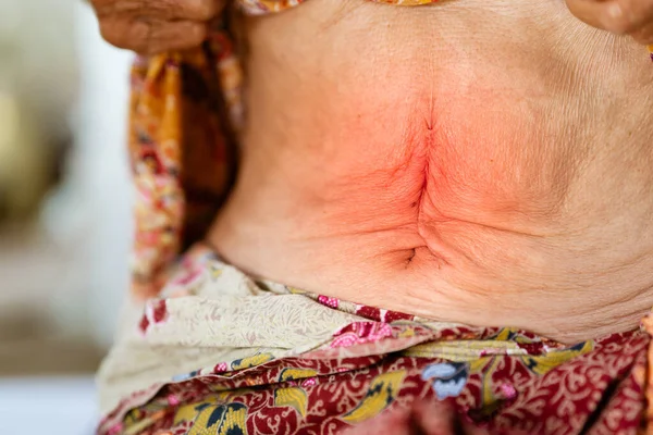 Abdominoplasty scars of an elderly woman with abdominal disease problems such as gastritis or inflammatory bowel disease.