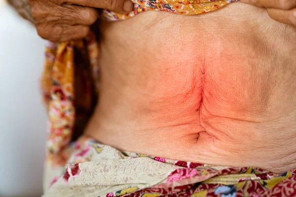 腹部疾患を有する高齢者の腹部手術創 — ストック写真