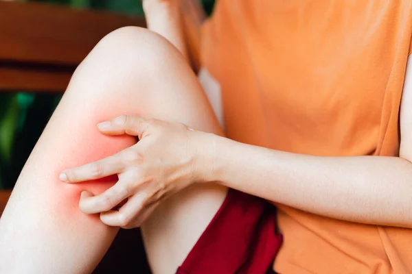 Kobieta Drapiąca Się Swędzącej Nodze Ugryzienia Owada Lub Alergii Koncepcja — Zdjęcie stockowe