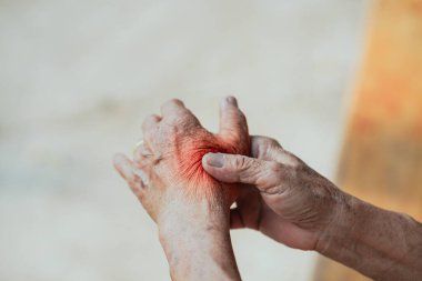 Bir elinde kırmızı tahriş olan yaşlı bir insanın ellerinin yakın çekimi, muhtemelen bulanık bir arkaplana karşı ağrı ya da deri durumunu gösteriyor..