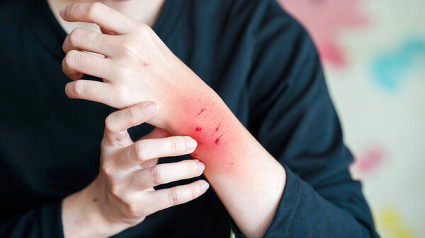 person with black shirt is scratching their arm, which has visible red scratch marks, possibly indicating irritation or allergic reaction.