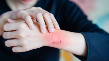 Kronik tahriş ve tedaviyi gösteren bir bilek ağrısı konsepti. Kırmızı iltihaplı deri ve bilek bölgesinde çizikler var.