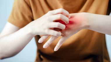 Elindeki tahriş olmuş deriyi tırmalayan, kızarıklığı ve rahatsızlığı gösteren, muhtemelen alerji, egzama veya böcek ısırığından kaynaklanan, sağlık ve dermatolojiyi ön plana çıkaran bir kişi.