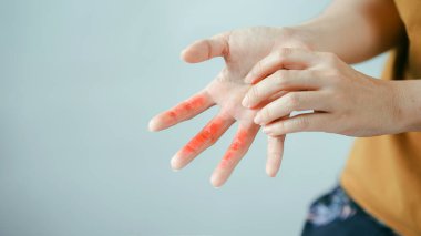Parmak uçlarında kırmızı iltihaplı deri olan insan, etkilenmiş bölge konseptine dokunuyor, cilt tahrişi alerjisi egzaması ya da deri iltihabı..