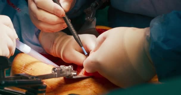 Közelkép Rákműtétről Szakképzett Sebészek Csapata Távolítsa Rákos Sejteket Gyomorból Modern — Stock videók