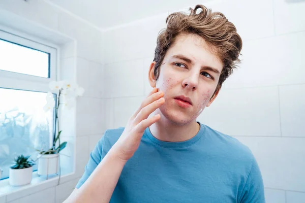 여드름 문제가 우울증에 소년은 집에서 관리를 거울을 화장실에서 얼굴에 크림을 — 스톡 사진