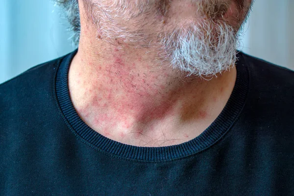 Allergi Hud Dermatit Mat Dermatit Symptom Problem Hudutslag Ansikte Sovande — Stockfoto