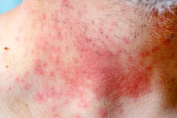 Allergi Hud Dermatit Mat Dermatit Symptom Problem Hudutslag Ansikte Sovande Royaltyfria Stockbilder
