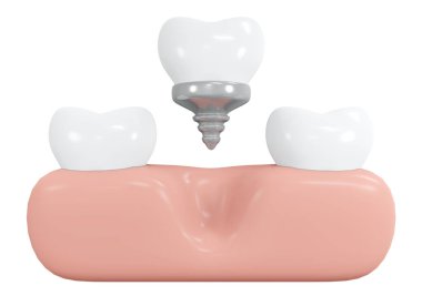 3D Rendering teeth with implant with gum tool icon cartoon style isolated on white. 3D Render illustration.
