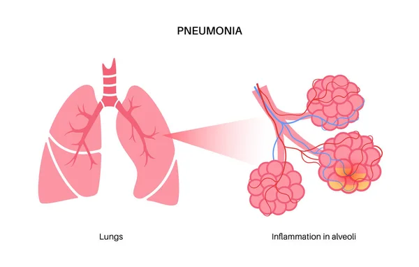 Анатомический Плакат Пневмонии Воспаление Дыхательной Системы Человека Болезнь Легких Гнойное — стоковый вектор