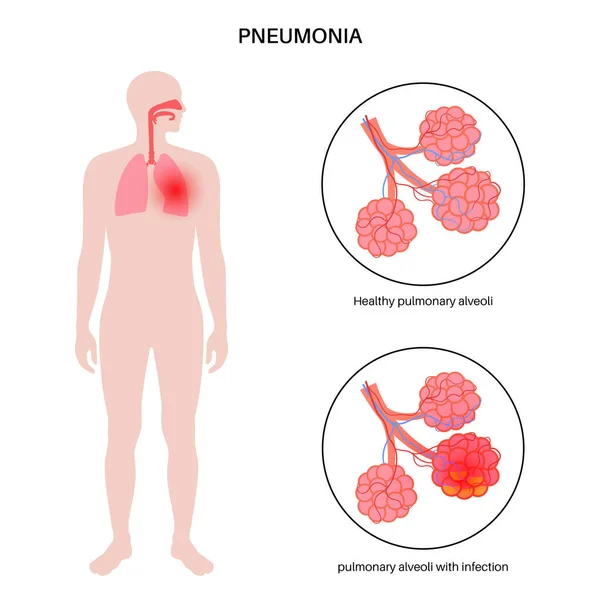 Affiche Anatomique Sur Infection Pneumonique Inflammation Système Respiratoire Humain Maladie — Image vectorielle