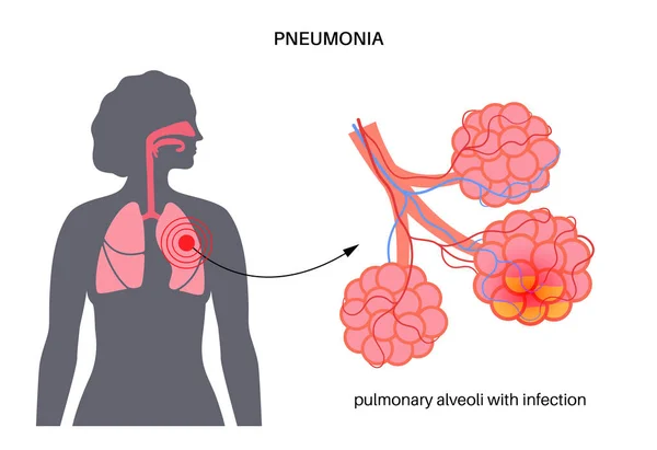 Poster Anatomico Infezione Polmonite Infiammazione Nel Sistema Respiratorio Umano Malattia — Vettoriale Stock
