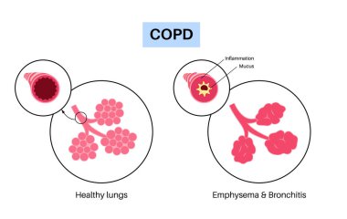 Kronik obstrüktif akciğer hastalığı ya da KOAH. Akciğer hastalığı grubu. Solunum yolları, hava keseleri, akciğerlerdeki mukus ve çökmüş alveollerde sorun var. İnsan solunum sistemi düz vektör illüstrasyonunun rahatsızlığı
