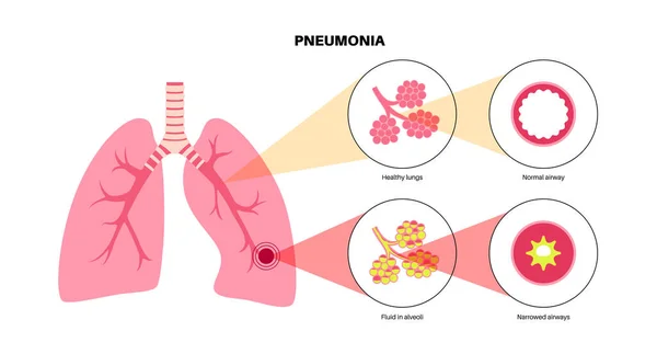 Zakażenie Płuc Plakat Anatomiczny Zapalenie Ludzkim Układzie Oddechowym Alveoli Płynem — Wektor stockowy