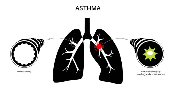 Concept Maladie Asthme Essoufflement Oppression Thoracique Causes Toux Voies Respiratoires — Image vectorielle