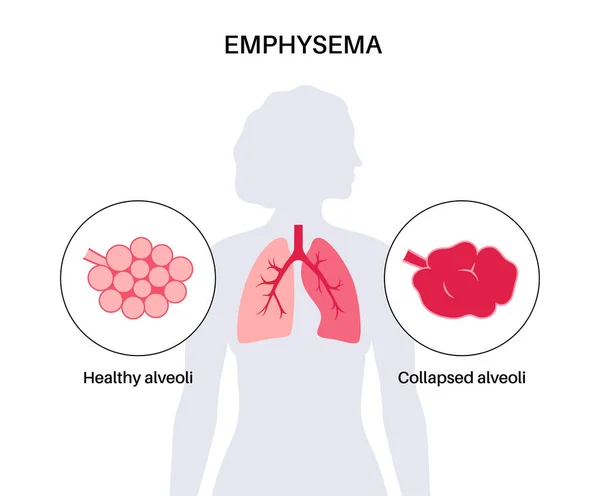 Amfizem Hastalığı Konsepti Hasarlı Alveoller Solunum Yolu Arızası Nsan Ciğerlerindeki — Stok Vektör