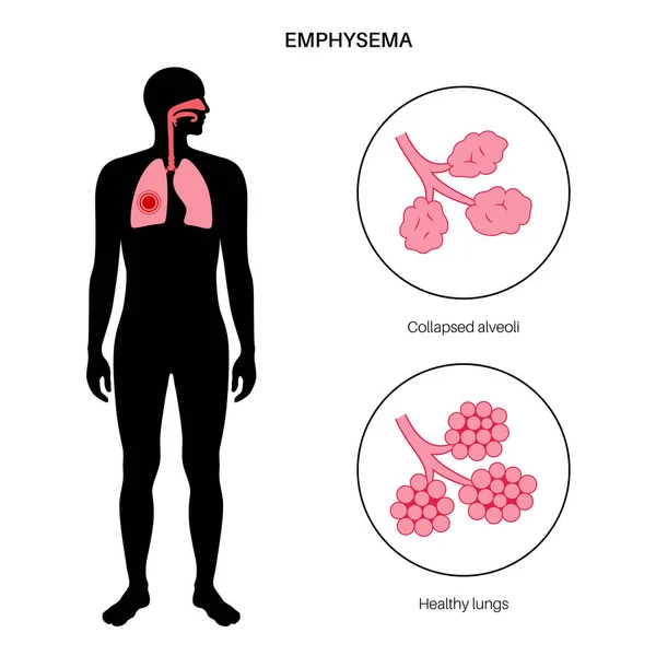 Emphysema Betegség Koncepció Megsérült Alveolusok Meghibásodott Légutak Lebegő Falak Légzsákok — Stock Vector