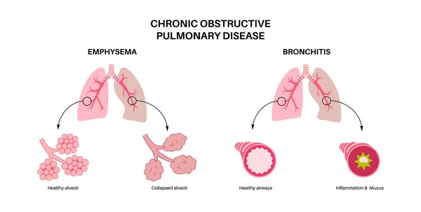 Krónikus Obstruktív Tüdőbetegség Vagy Copd Tüdőbetegség Gond Van Légutakkal Légzsákokkal — Stock Vector